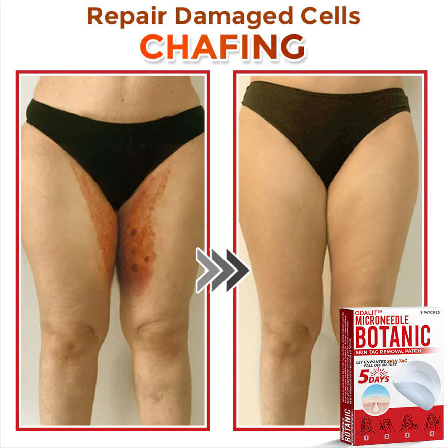 👩‍⚕️𝑶𝒇𝒇𝒊𝒄𝒊𝒂𝒍 𝑺𝒕𝒐𝒓𝒆 | ODALIT™ Gentle Microneedle Patches for Skin Tag & Mole Removal