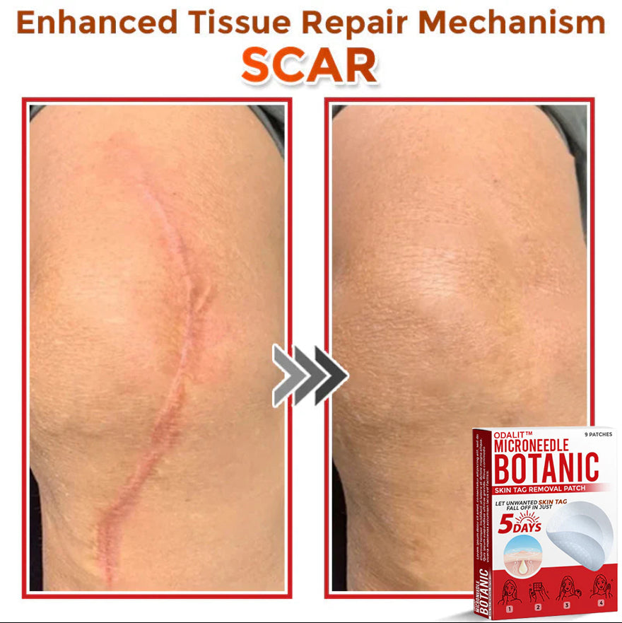 👩‍⚕️𝑶𝒇𝒇𝒊𝒄𝒊𝒂𝒍 𝑺𝒕𝒐𝒓𝒆 | ODALIT™ Gentle Microneedle Patches for Skin Tag & Mole Removal